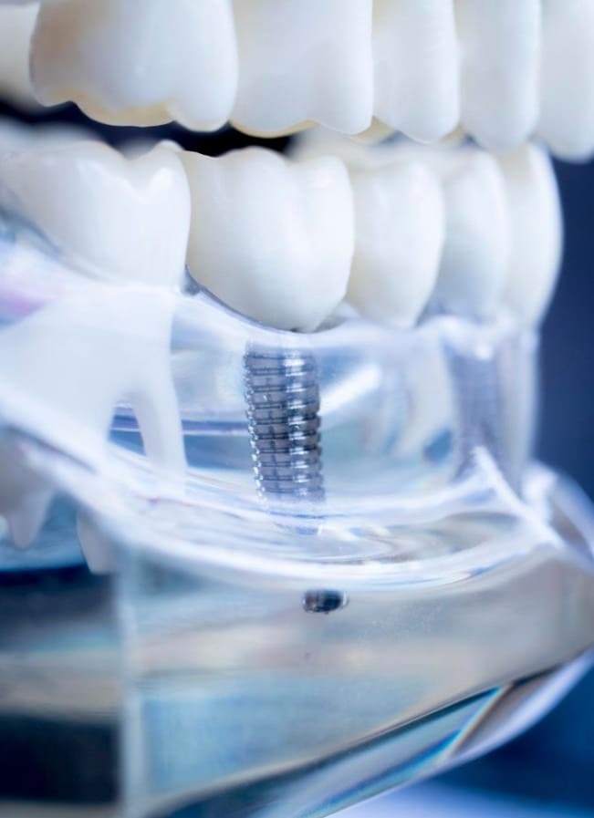 robladent prosperidad implante dental modelo maxilar